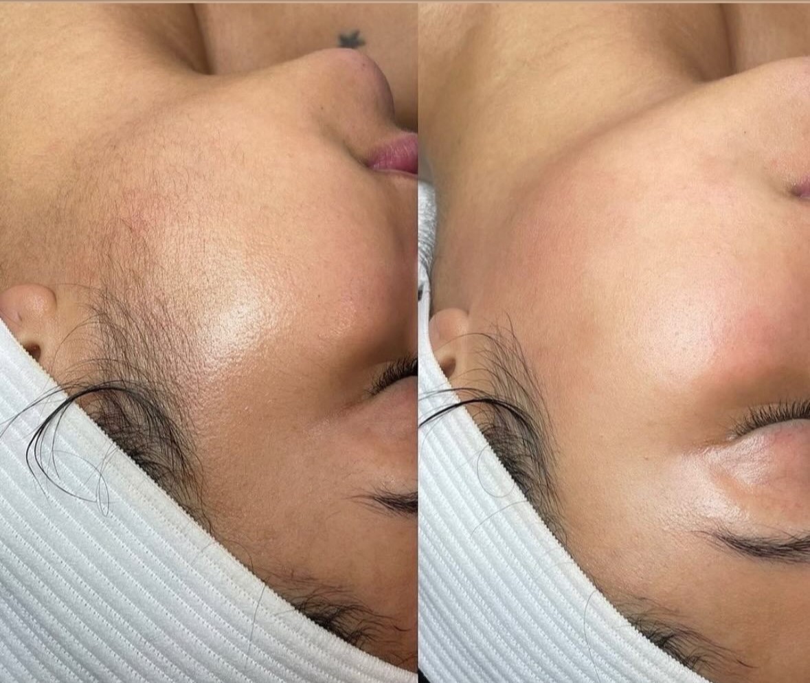Haut vor und nach einer Dermaplaning Behandlung