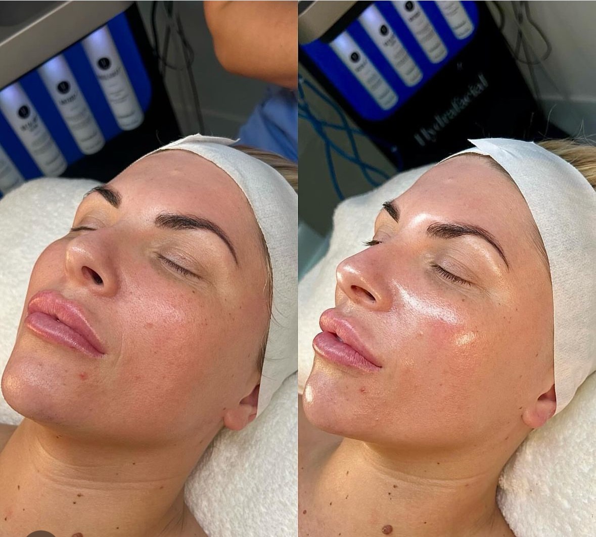 Haut vor und nach einer Hydrafacial™ Behandlung